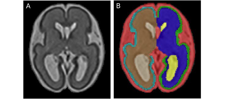 Identifican un biomarcador fetal para el pronóstico de las alteraciones neurológicas