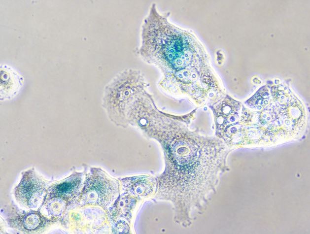 Las células senescentes podrían favorecer en algunas circunstancias la progresión maligna del tumor