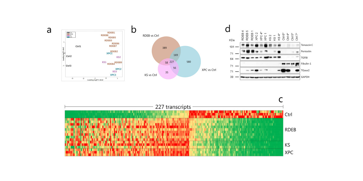 Identifican una firma genética común en tres enfermedades raras de la piel con propensión al cáncer