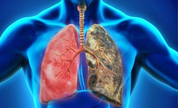 Nuevos avances en el papel del microambiente tumoral en el cáncer de pulmón en pacientes con EPOC