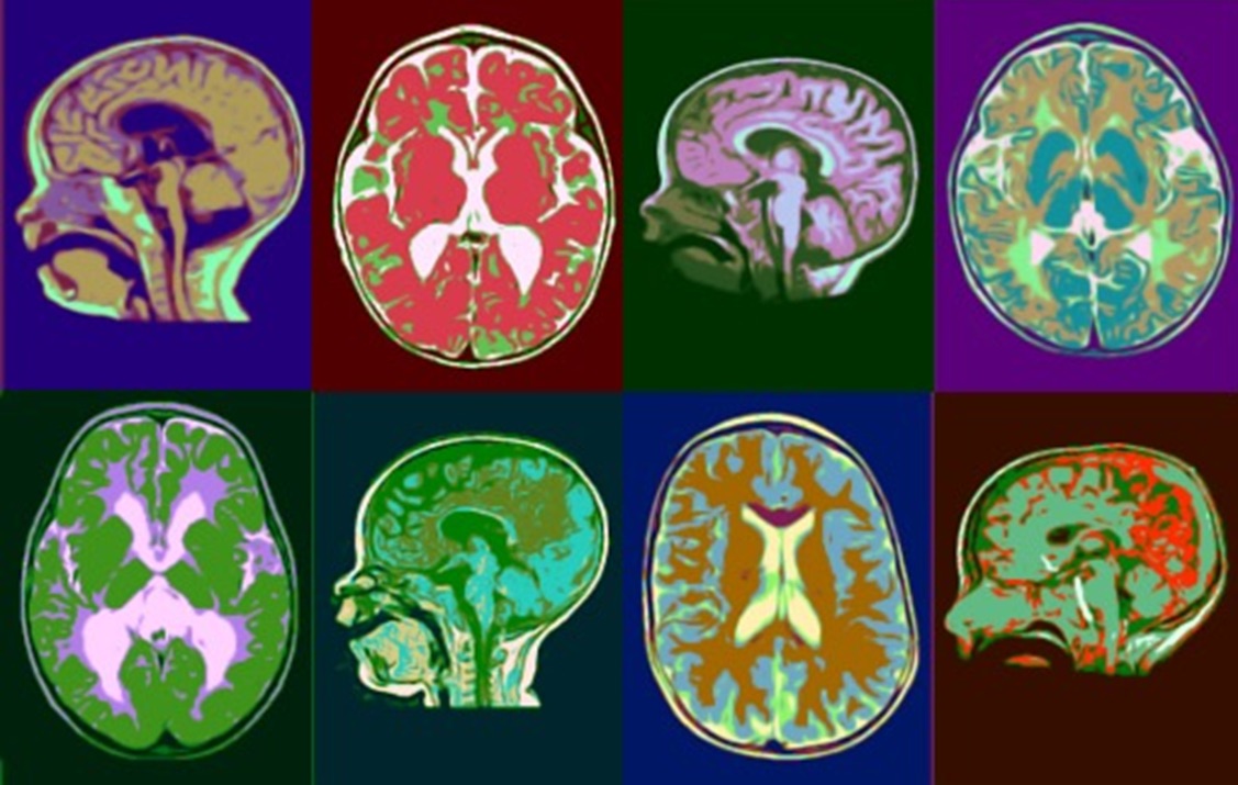 El fingolimod, designado medicamento huérfano para el tratamiento de la adrenoleucodistrofia