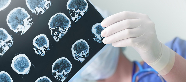 La falta de proteína priónica celular podría provocar síntomas de epilepsia y déficits de aprendizaje