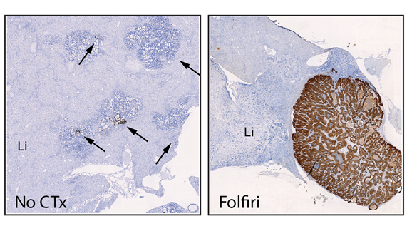 Científicos descubren la clave de la reaparición del cáncer  de colon después de la quimioterapia Científicos descubren la clave de la reaparición del cáncer  de colon después de la quimioterapia