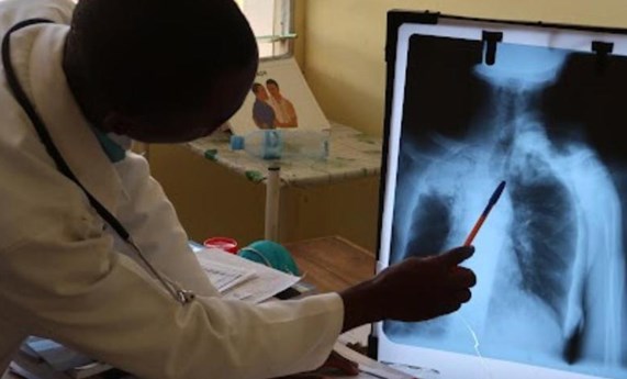 La tuberculosis resistente a fármacos podría estar infradiagnosticada, según un análisis genómico en el sur de Mozambique La tuberculosis resistente a fármacos podría estar infradiagnosticada, según un análisis genómico en el sur de Mozambique