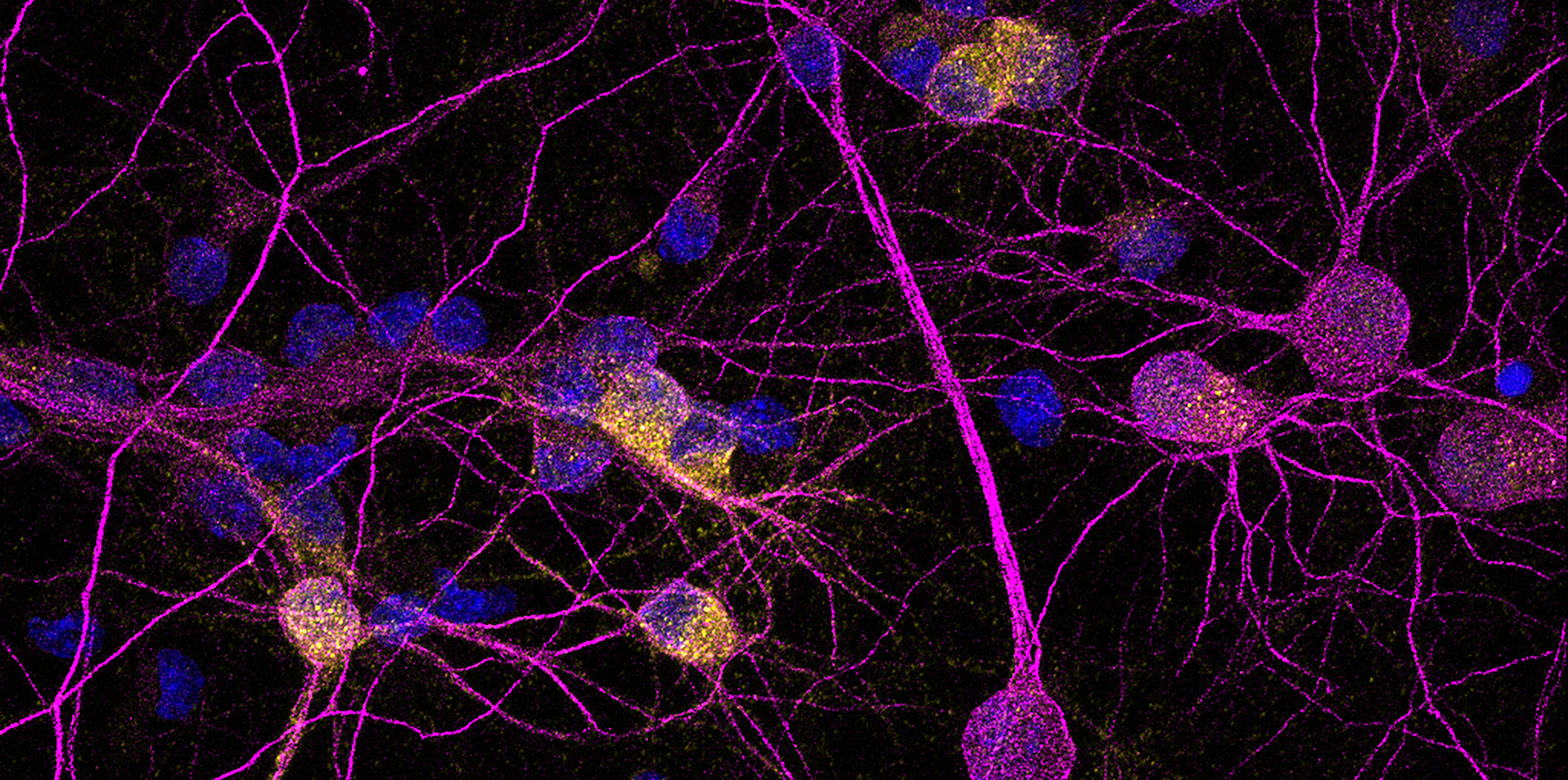 Identifican un factor clave para la supervivencia de las neuronas en la Enfermedad de Huntington