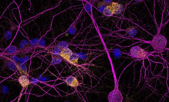 Identifican un factor clave para la supervivencia de las neuronas en la Enfermedad de Huntington Identifican un factor clave para la supervivencia de las neuronas en la Enfermedad de Huntington