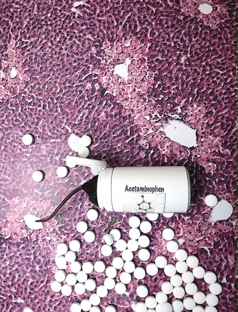 Nueva terapia para el daño hepático fulminante por paracetamol